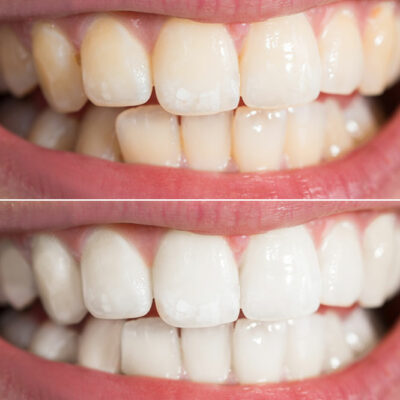 5 Teeth Whitening Procedures for Brighter Teeth