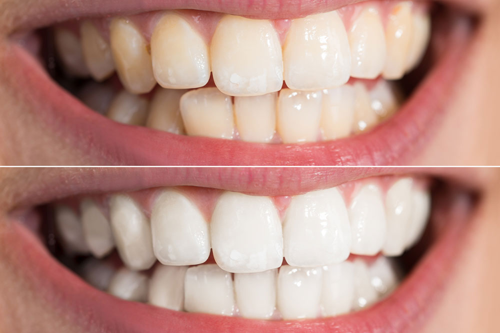 5 Teeth Whitening Procedures for Brighter Teeth