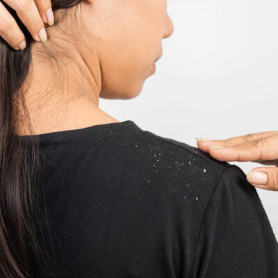 5 Tips for A Dandruff-Free Scalp