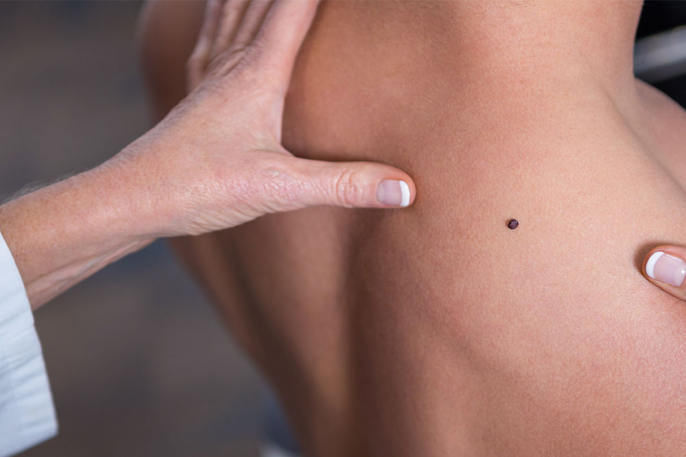 6 Factors That Increase the Risk of Melanoma